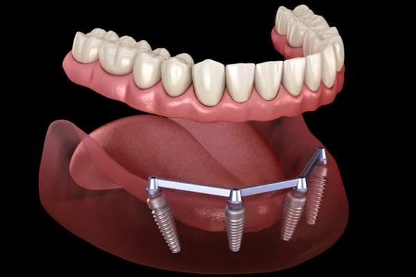 01-featured-full-mouth-implants