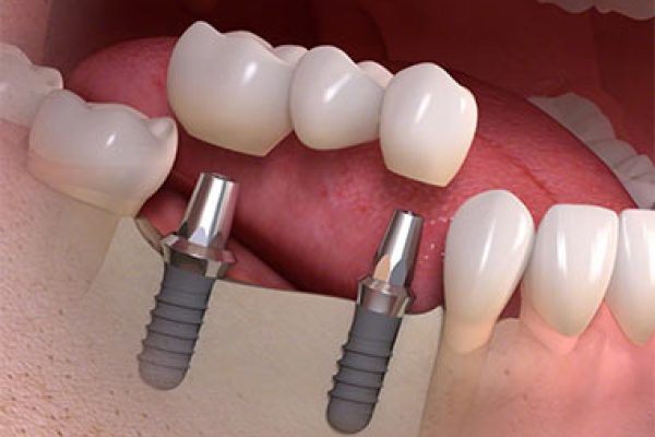 multiple-teeth-implants
