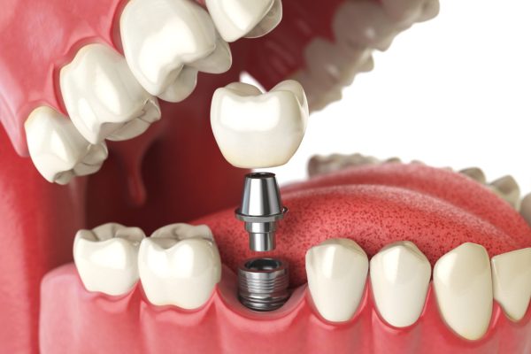 Tooth human implant. Dental concept. Human teeth or dentures. 3d illustration